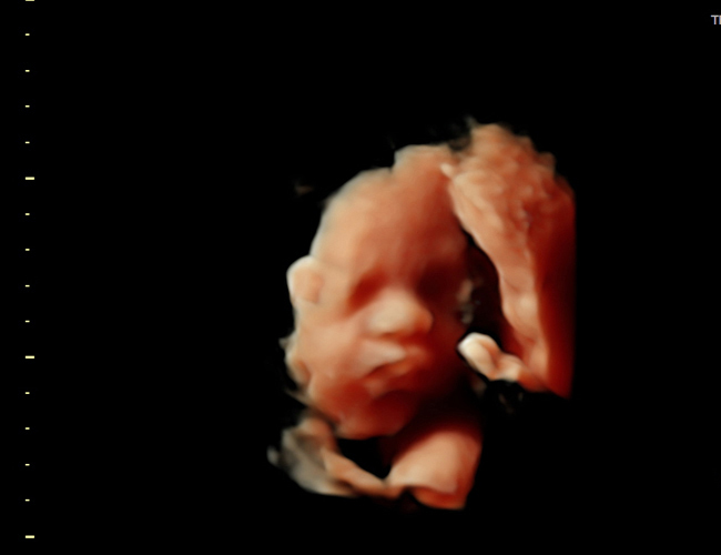 3D ultrasound image at 29 weeks
